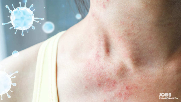 คนทำงานควรรู้ อาการผื่นขึ้น สัญญาณบ่งชี้ติดเชื้อโควิด-19